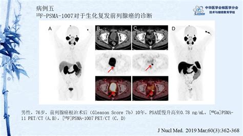 中华医学会核医学分会 讲座 讲座8018F PSMA 1007在前列腺癌中的应用 程祝忠