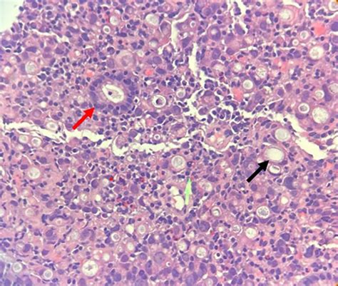 Krukenberg tumor, causes, symptoms, diagnosis, treatment & prognosis