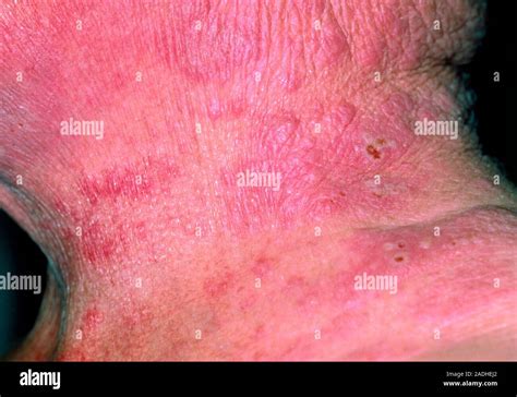 Eczema And Shingles Neck Of A Patient With Acute Eczema Skin Inflammation And A Herpes Zoster