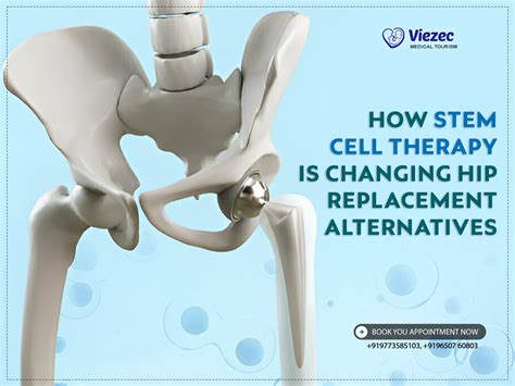 Stem Cell Therapy S Promise For Hip Replacement Alternatives