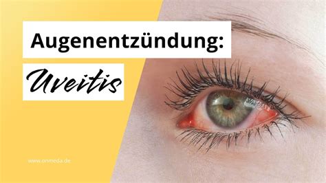 Uveitis Entz Ndung Im Augeninneren Youtube