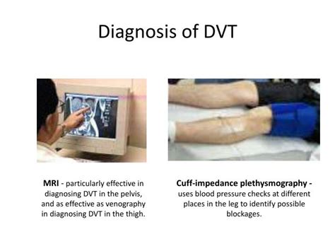 Ppt Deep Vein Thrombosis Powerpoint Presentation Id5393294