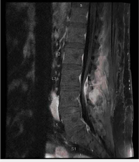 T1 Flair Sagittal Section Showing L3 L4 Facet Joint Septic Arthritis