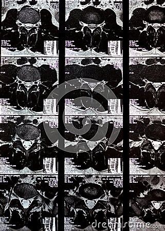 Cairo Egypt November Mri Of Lumbosacral Spine Revealed