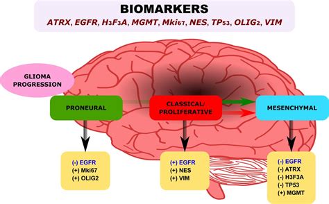 View 14 Glioblastoma Multiforme Symptoms - artalijahnewpro70