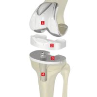 Knie Vollprothese Tep Op Und Nachbehandlung Sportklinik Ravensburg