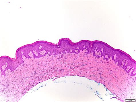 Frictional Keratosis Histology