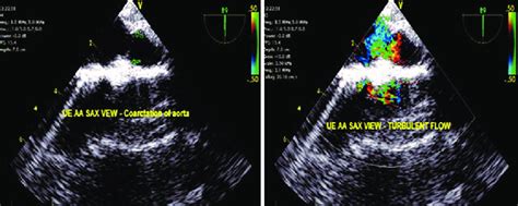 A Upper Esophageal Aortic Arch Short Axis View Demonstrating The