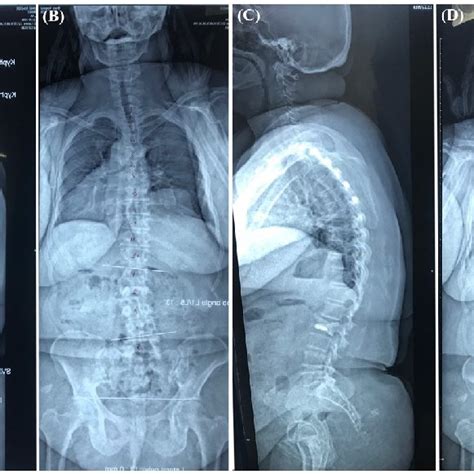 Preoperative Lateral A Anteroposterior B Standing Full Length