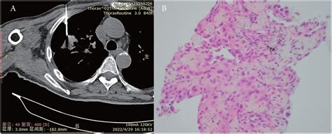 Frontiers Case Report Rare Intrapulmonary Malignant Mesothelioma