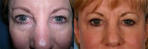 Patient 333526 Eyelid Surgery Blepharoplasty Before And After Photos Buckingham Center For