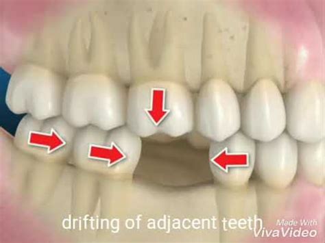 Consequences Of Not Replacing Missing Tooth YouTube