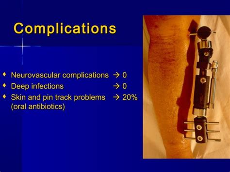 Upper Tibial Valgus Osteotomy Using A Dynamic External Fixator Ppt