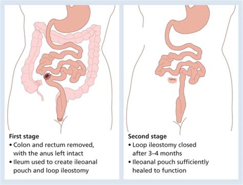 Proctocolectomy With J Pouch