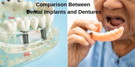 Dental Implants Vs Dentures Choosing The Right Option For You