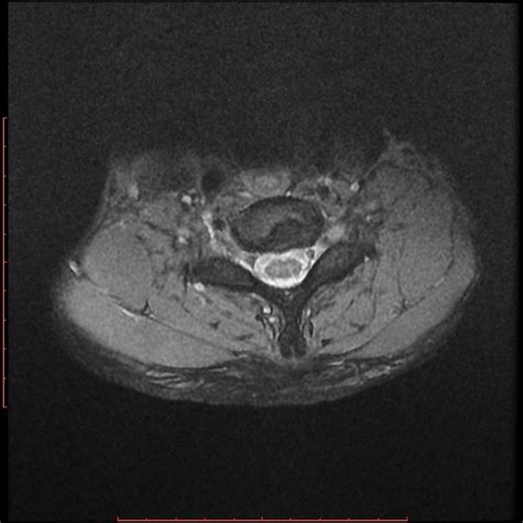 Ankylosing Spondylitis Image