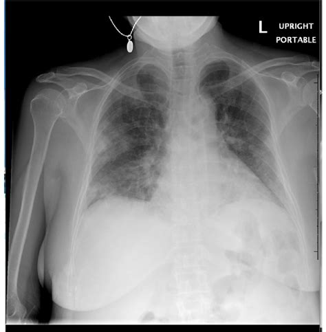 Chest Radiography Demonstrating Bilateral Peripheral Predominant