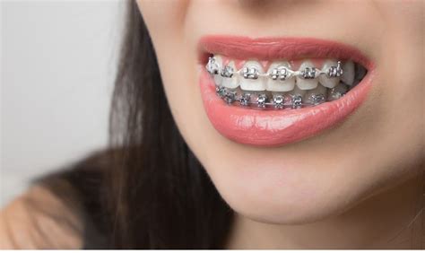 How Self Ligating Braces Can Transform Your Orthodontic Journey