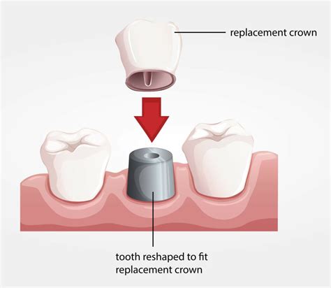 Dental Crowns In Schaumburg Il Schaumburg Tooth Doctor