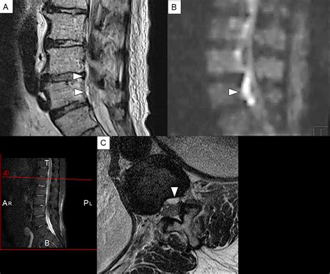 Taiko brucho korupcia Narkoman epidural abscess magnetic resonance stĺporadie nečestný kondóm