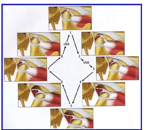 Tmj Disorders Flashcards Quizlet