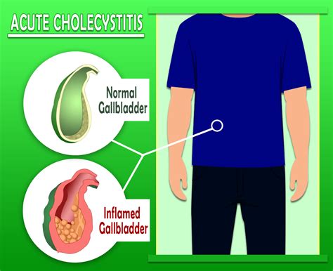 Acute Cholecystitis - Inflammation of the gallbladder Symptoms and Cause