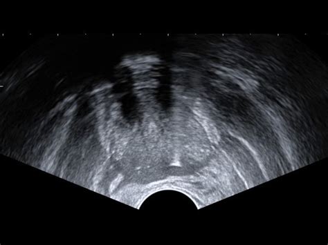 Transrectal Ultrasound Prostate Biopsy