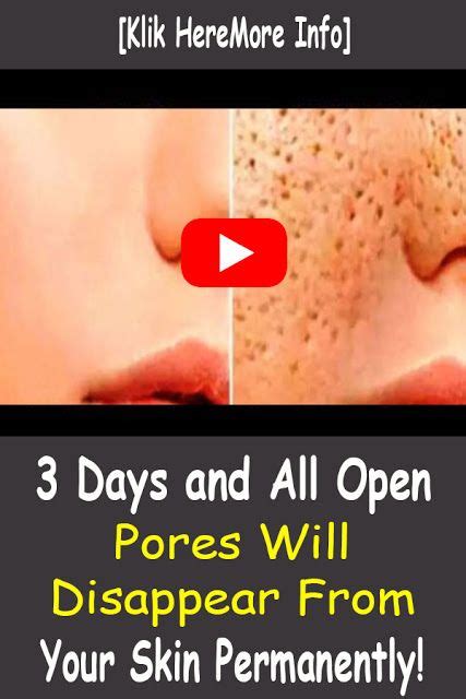 Get Rid Of Large Open Pores Permanently Pore Skin Care Skin