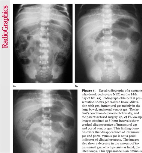 Figure From Necrotizing Enteroco Litis Review Of State Of The Art