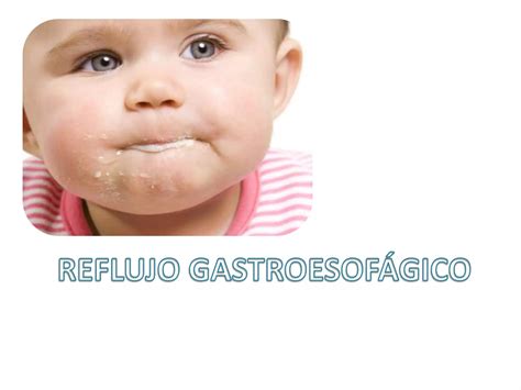 Reflujo Gastroesofágico Ppt