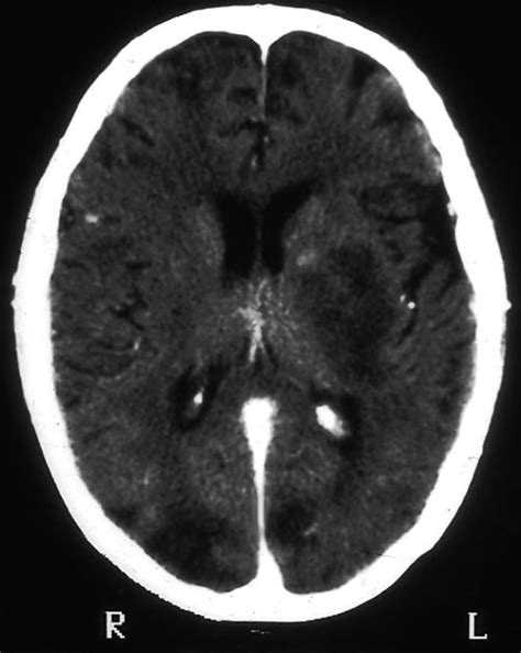 Brain Aspergillus And Aspergillosis