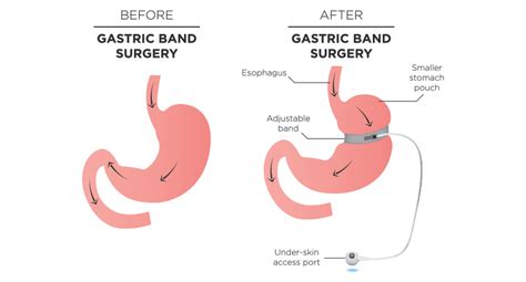 Gastric Lap Band Surgery | How can it help you with Weight Loss?