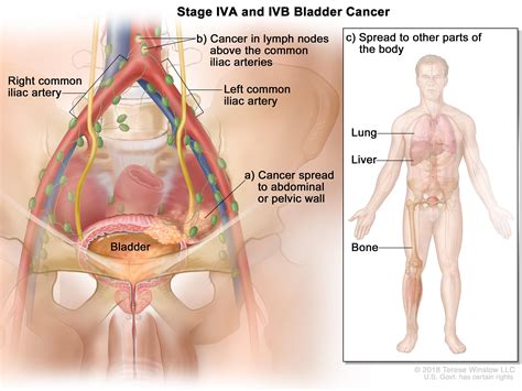 Erdafitinib Effective Against Advanced Bladder Cancer Nci