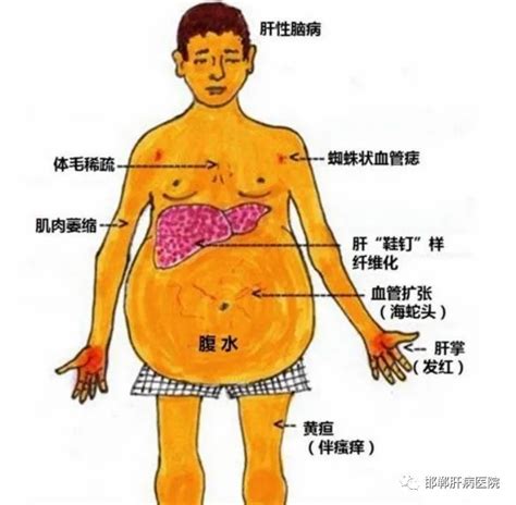 肝硬化腹水、癌性腹水的治疗患者