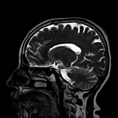 Radiopaedia Case Craniopharyngioma Nos Id Study Nc Commons