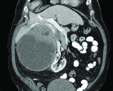 CT Abdomen And Pelvis Showing The Right Retroperitoneal Mass Displacing