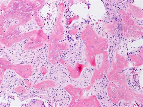 Osteosarcoma Histology