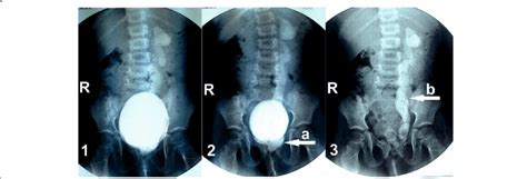 Voiding Cystography Iv Grade Vesicoureteral Reflux In The Upper