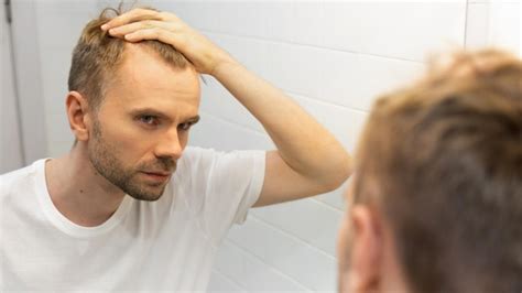 Hypothyroidism Hair Loss Men