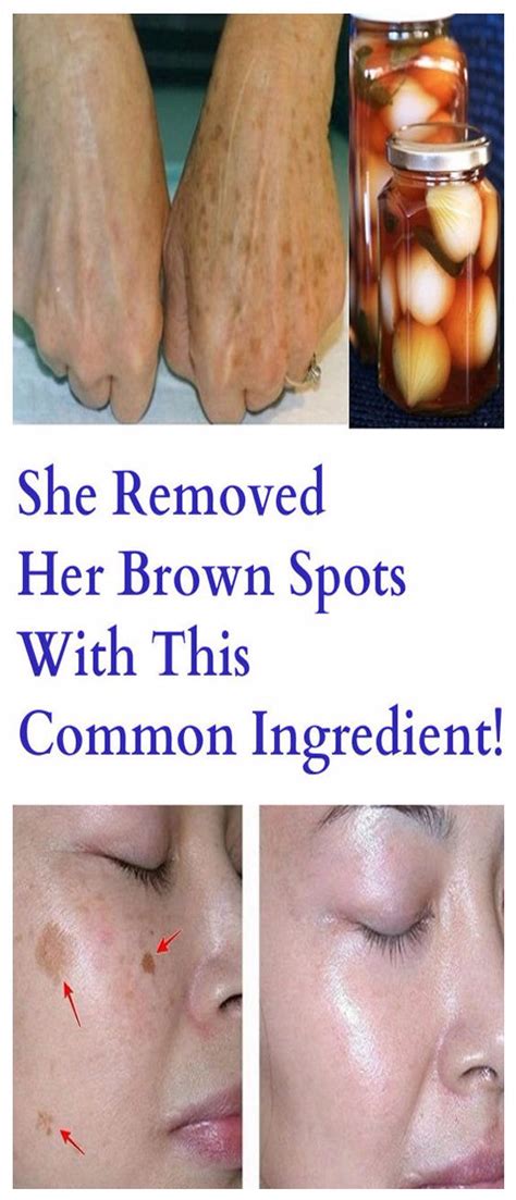 She Removed Her Brown Spots With This Common Ingredient Amazing Health Diy And Crafts