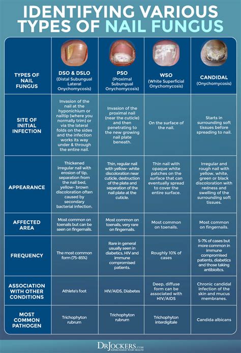 Toenail Fungus: Symptoms, Causes and Support Strategies