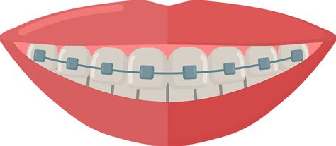 Free Braces Cliparts Download Free Braces Cliparts Png Images Clip