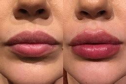 Volbella Fillers For Lip In Dubai Abu Dhabi Volbella Cost Price