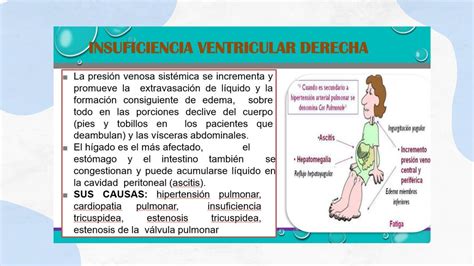 Insuficiencia Ventricular Derecha Alxnsx S Udocz