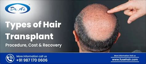 Types Of Hair Transplant Procedure Cost And Recovery Fusehair