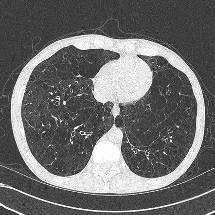 Emphysema Radiology