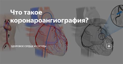 Что такое коронароангиография? | Анна Кореневич | Врач-кардиолог ...