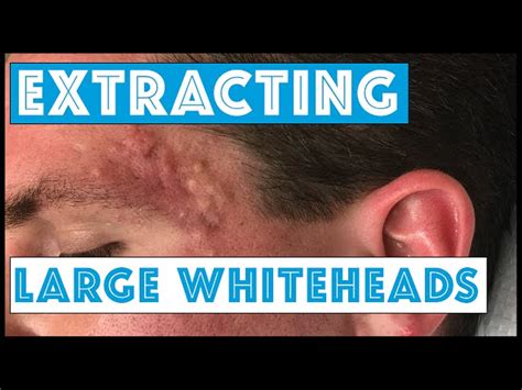 Acne Whiteheads