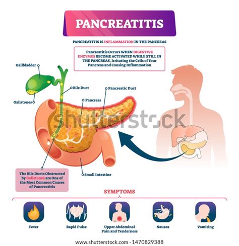 Pancreatitis Vector Illustration Labeled Sick Pancreas