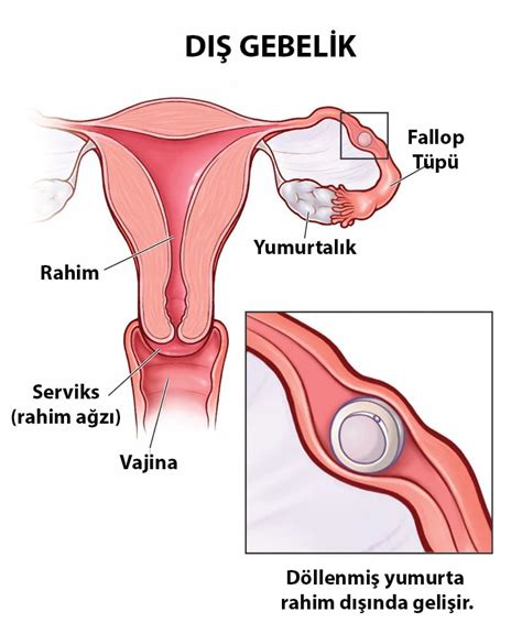 D Gebelik Nedir D Gebelik Belirtileri Nedir Op Dr G N L Imen